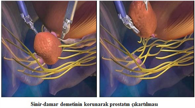 DDH’DE BİR İLK RADİKAL PROSTATEKTOMİ AMELİYATI