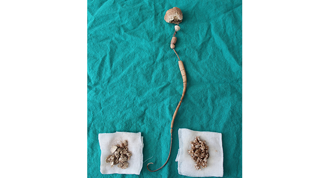 BÖBREĞİNDEN 30 CM TAÇ ÇIKTI