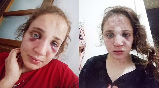 3 çocuk annesi Özlem'i düşmanı değil kocası bu hale getirdi