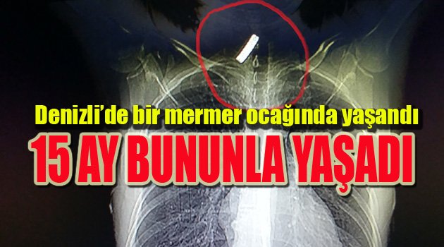 15 AY BOYUNCA BOĞAZINDA 4 CM’LİK DEMİR PARÇASI İLE YAŞAMIŞ