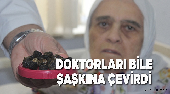 Safra kesesinden çıkan taşlar doktorları bile şaşkına çevirdi