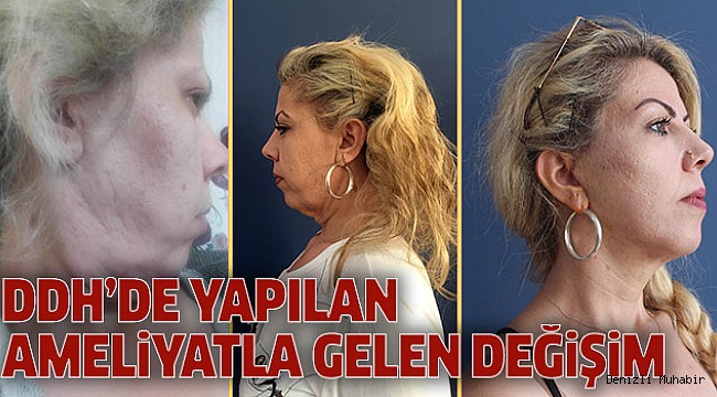 ÖNCE KİLODAN SONRA SARKMALARINDAN KURTULDU