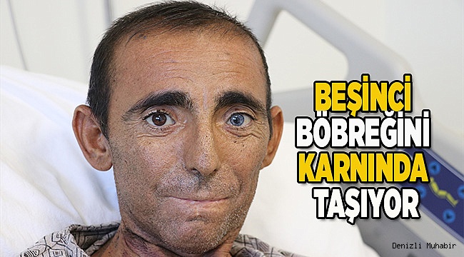 BEŞİNCİ BÖBREĞİNİ KARNINDA TAŞIYOR