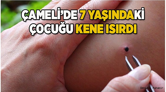 Çameli'de 7 yaşındaki çocuğu kene ısırdı