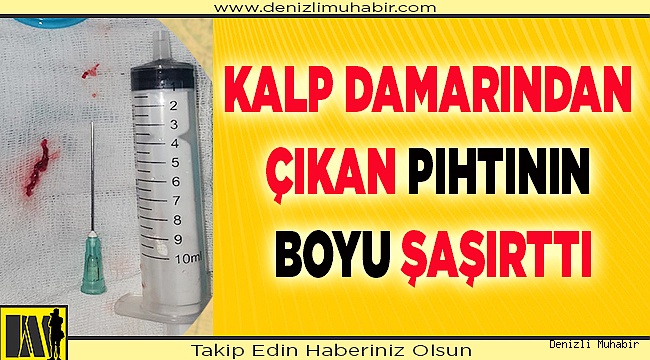KALP DAMARINDAN ÇIKAN PIHTININ BOYU ŞAŞIRTTI
