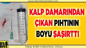 KALP DAMARINDAN ÇIKAN PIHTININ BOYU ŞAŞIRTTI