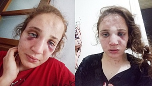3 çocuk annesi Özlem'i düşmanı değil kocası bu hale getirdi
