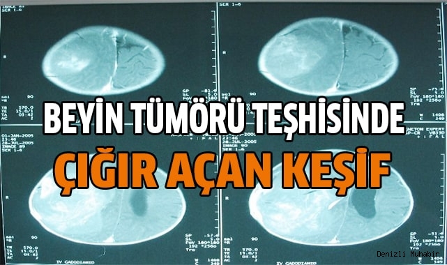 Beyin tümörü teşhisinde çığır açıldı