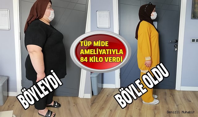 Tüp mide ameliyatıyla 84 kilo veren genç kız, hastalıklardan da kurtuldu