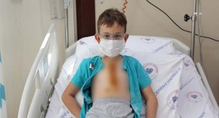 Minik kalpteki delik  tedavi edildi