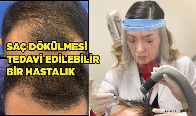 Saç Dökülmesi Tedavi Edilebilir Bir Hastalıktır