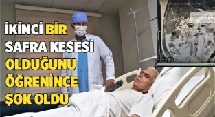 ikinci bir safra kesesi olduğunu öğrenince şok oldu