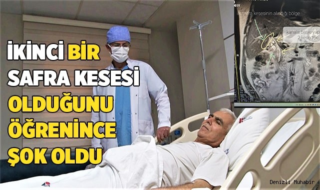 ikinci bir safra kesesi olduğunu öğrenince şok oldu