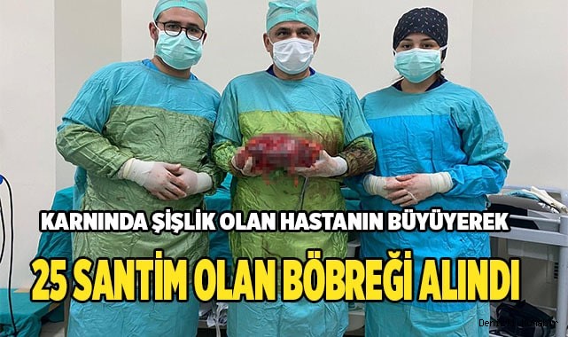 Büyüyerek  25 santim olan böbreği alındı