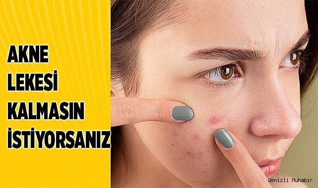 Akne Tedavisine İz ve Lekeler Oluşmadan Başlanmalı