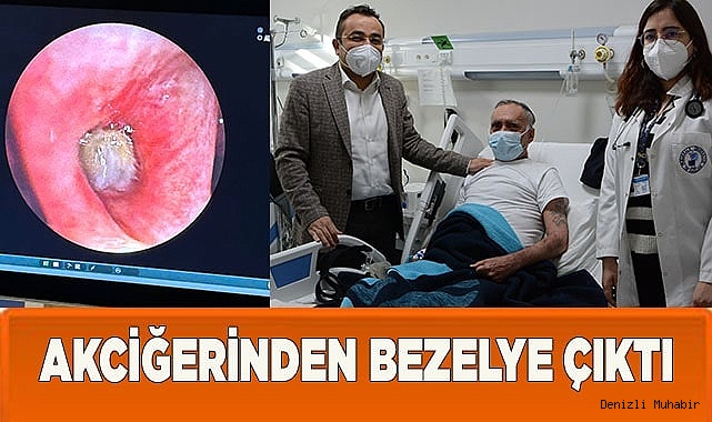 Akciğerde Beklenmedik Görüntü: Bezelye Başarıyla Çıkartıldı