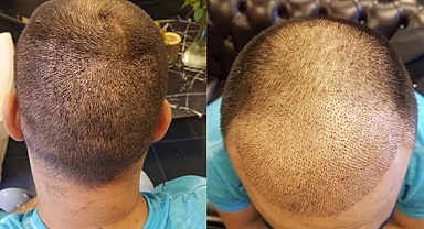 Saç Ekimi Nedir? Neden Önerilir?