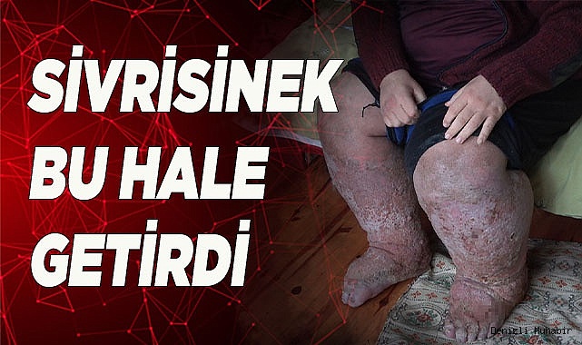 Sivrisinek, güvenlik görevlisinin hayatını kararttı