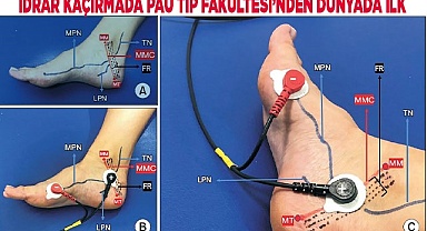 İdrar kaçırmada PAÜ Tıp Fakültesi’nden dünyada ilk