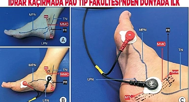 İdrar kaçırmada PAÜ Tıp Fakültesi’nden dünyada ilk