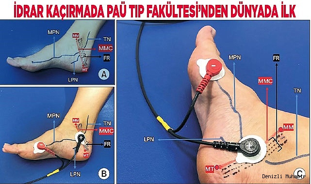İdrar kaçırmada PAÜ Tıp Fakültesi’nden dünyada ilk