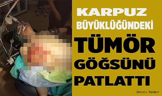 Tümör göğsünü patlattı