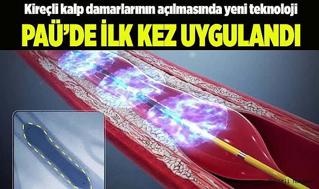 Kireçli kalp damarlarının açılmasında yeni teknoloji