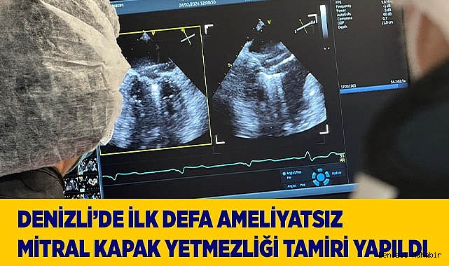 Denizli’de ilk defa ameliyatsız mitral kapak yetmezliği tamiri yapıldı