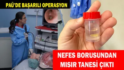 Nefes borusuna kaçan mısır tanesi çıkarıldı
