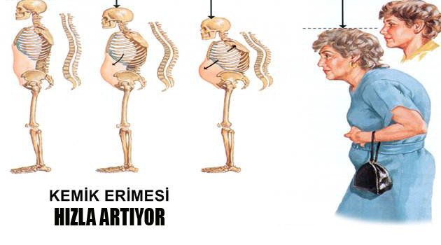 KEMİK ERİMESİNE YAKANALANLARIN SAYISI HIZLA ARTIYOR