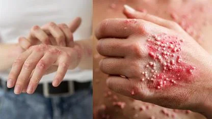 50 YAŞÜSTÜ İÇİN: VÜCUDUNUZDAKİ VİRÜS HER AN UYANABİLİR!