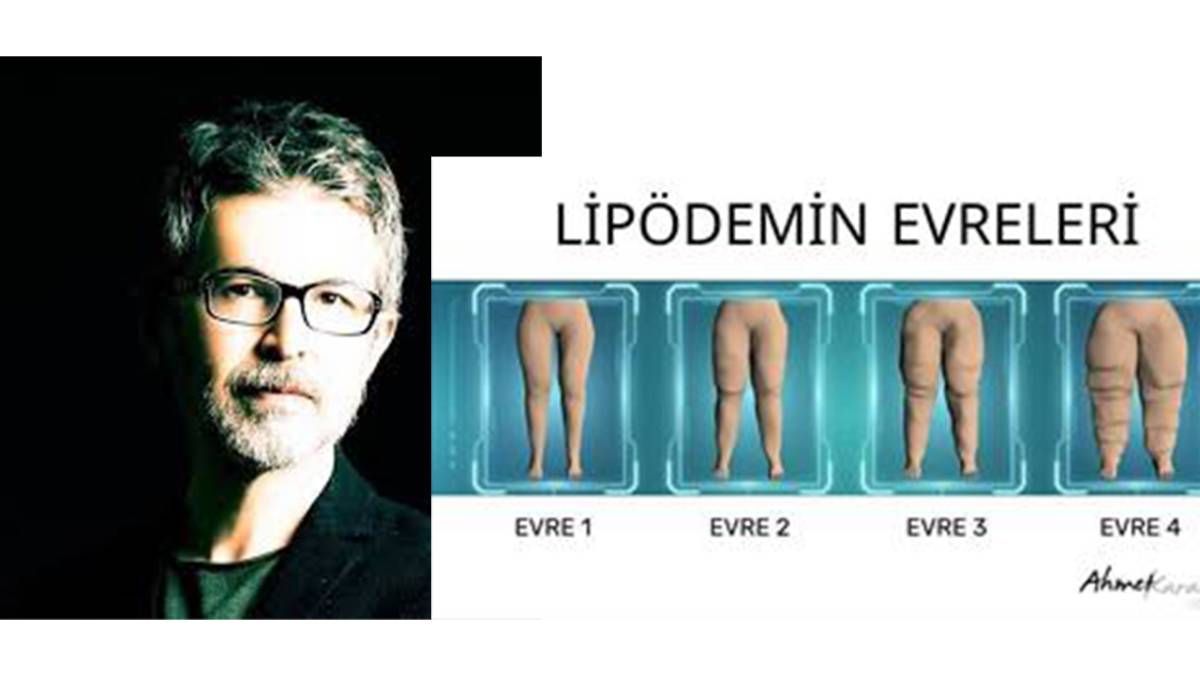 Avrupalı Lipödem Hastalarının Yeni Rotası: Neden İstanbul?